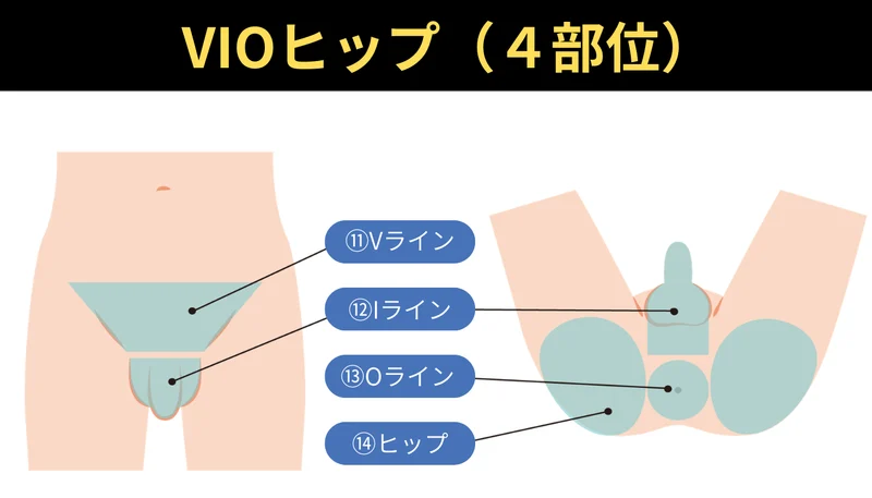 VIOヒップ（4部位）